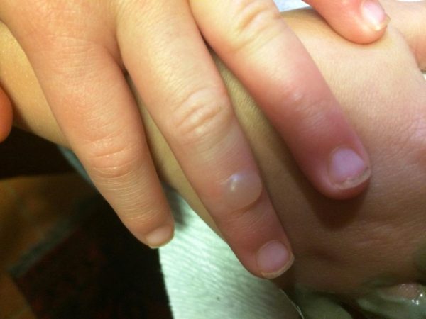 Blister caused from poison hemlock contact on 4-year old girl.